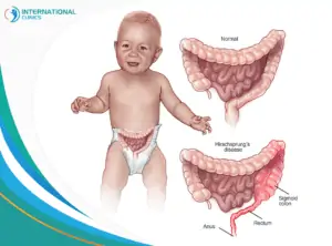 Hirschsprung s disease in children جراحة العظام والمفاصل