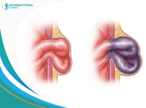 Intestinal hernia التهابات الزائدة