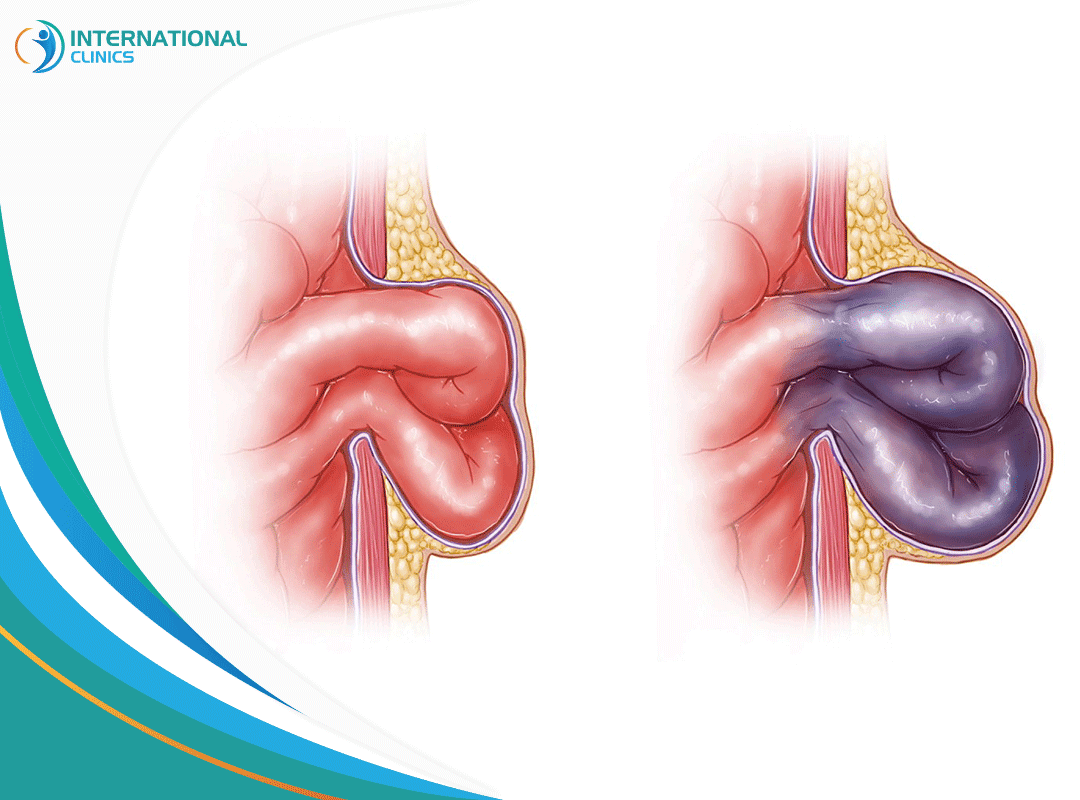 Intestinal hernia رتق الأمعاء