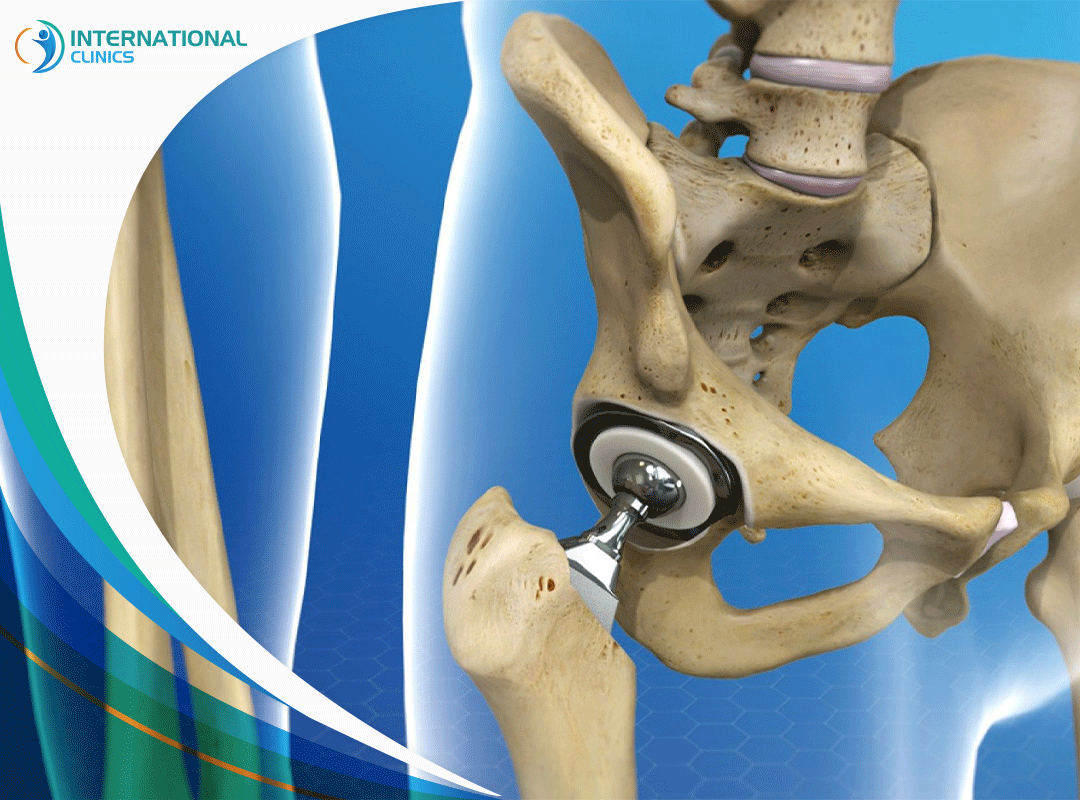 Joint replacement surgery 1 استبدال المفاصل