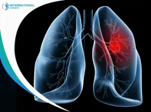 Lung Cancer علاج سرطان القولون