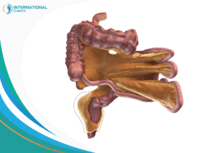Mesorectum removal استئصال بطني عجاني, استئصال بطني عجاني