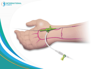 Peripheral artery catheterization تبديل الشرايين الكبيرة