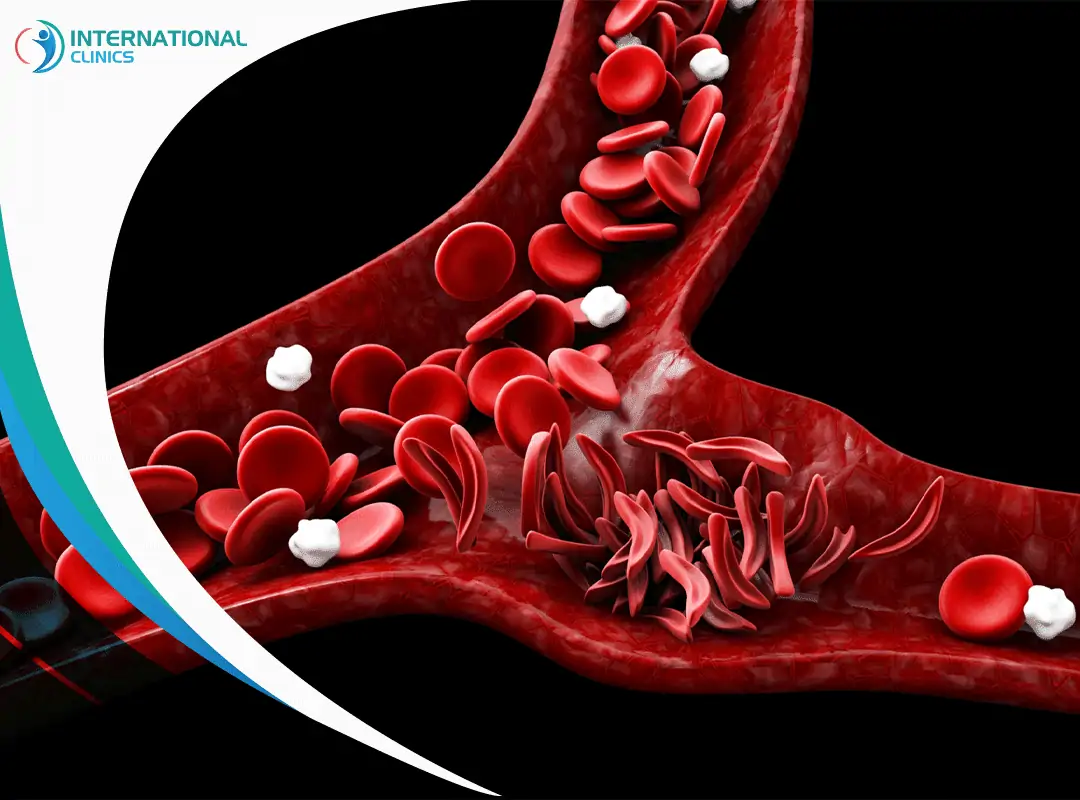 Sickle cell anemia فقر الدم المنجلي, فقر الدم المنجلي