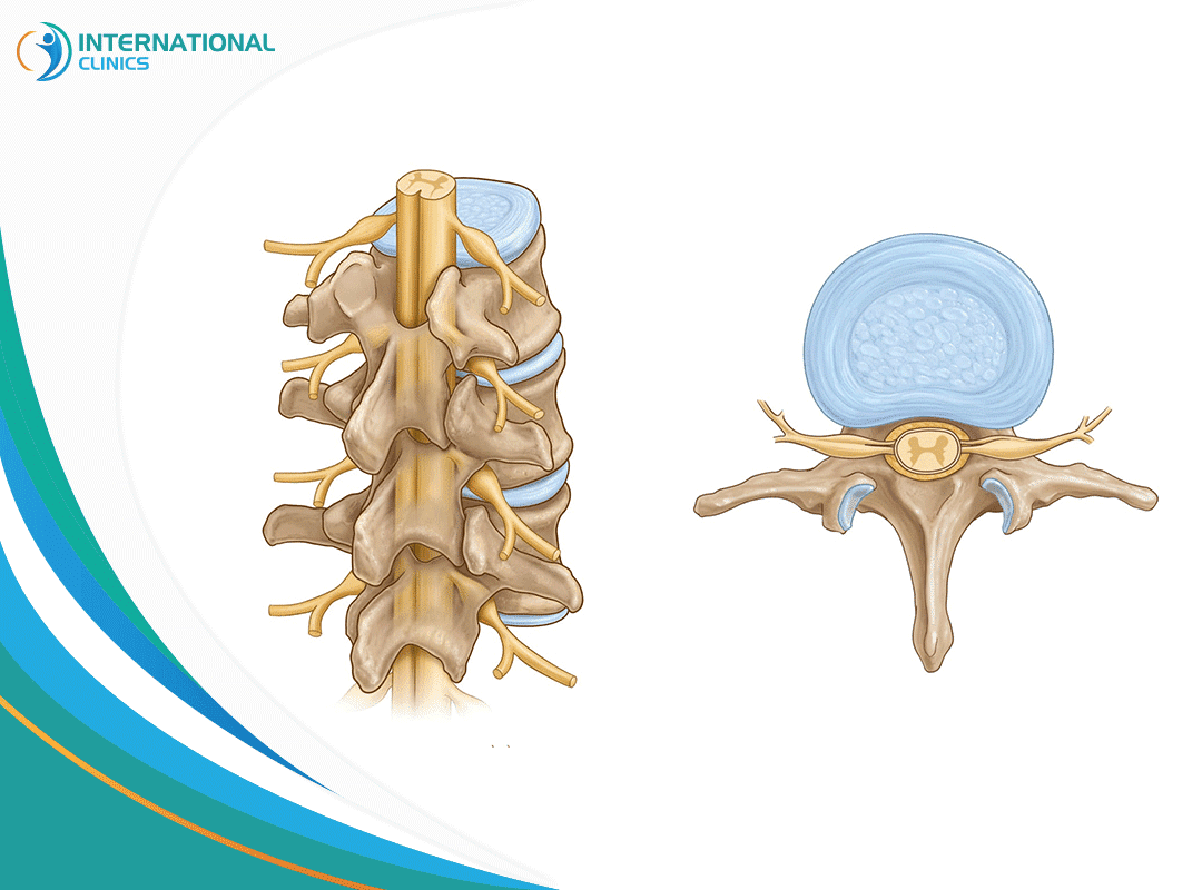 Spinal cord tumor surgery أورام الحبل الشوكي