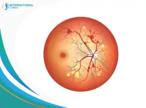 Treatment of intraocular hemorrhage for diabetes Uveitic Macular Edema