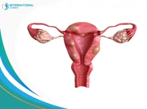fibroids أعراض سرطان عنق الرحم