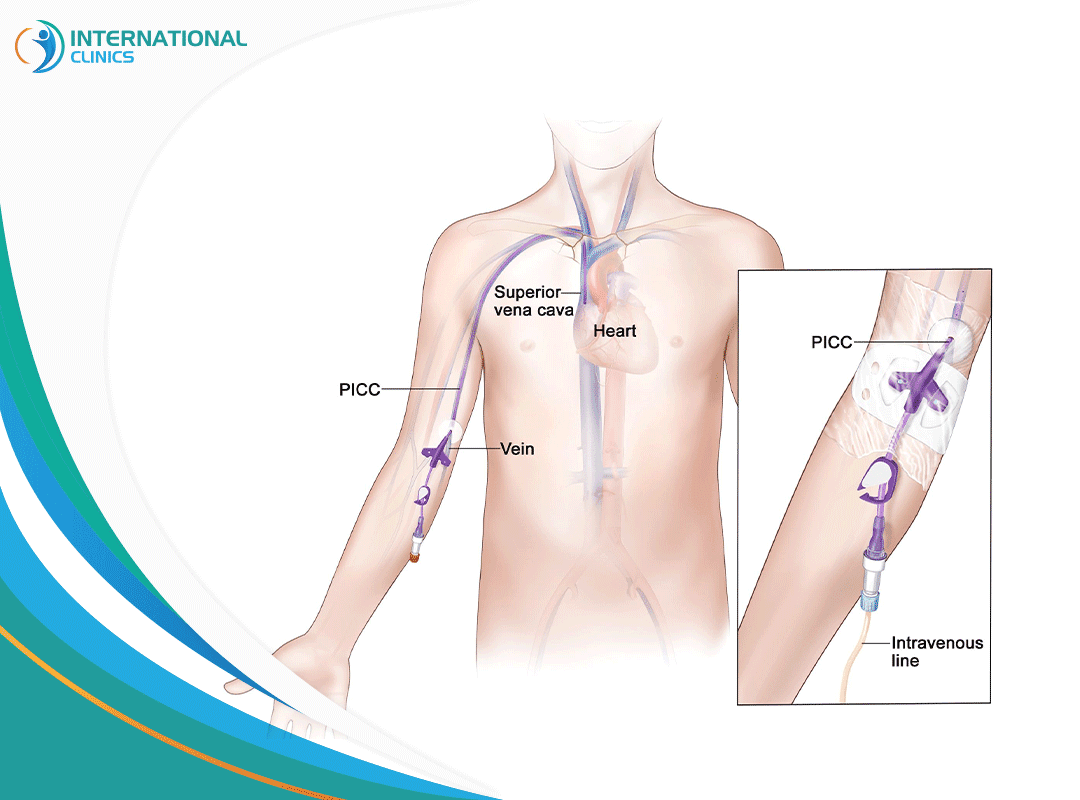 intravenous catheterization قسطرة الوريد