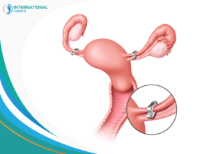 ligation of the uterine canals العقم عند النساء