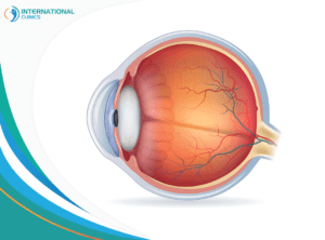 macular hole 2 Glaucoma