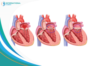 mitral valve عمليات مجازة التاجي في القلب المفتوح, عمليات مجازة التاجي في القلب المفتوح