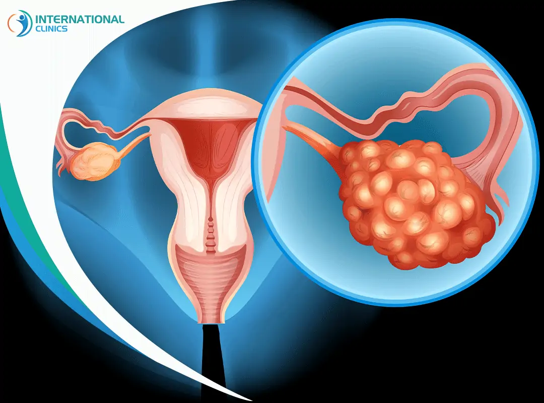 ovarian cancer سرطان المبيض