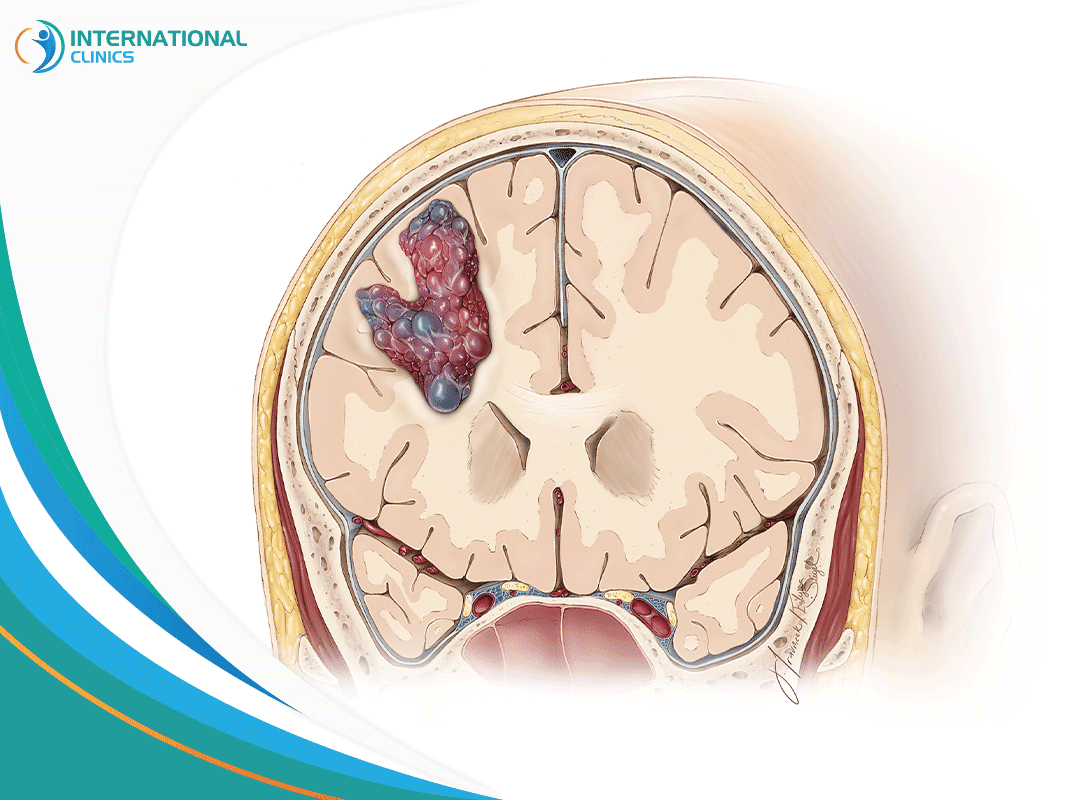 resection of brain tumors الاورام الدماغية, الاورام الدماغية