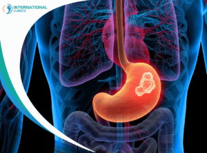 stomach cancer التنكس البقعي