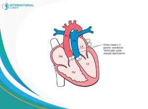 transposition of the great arteries عمليات القلب المفتوح