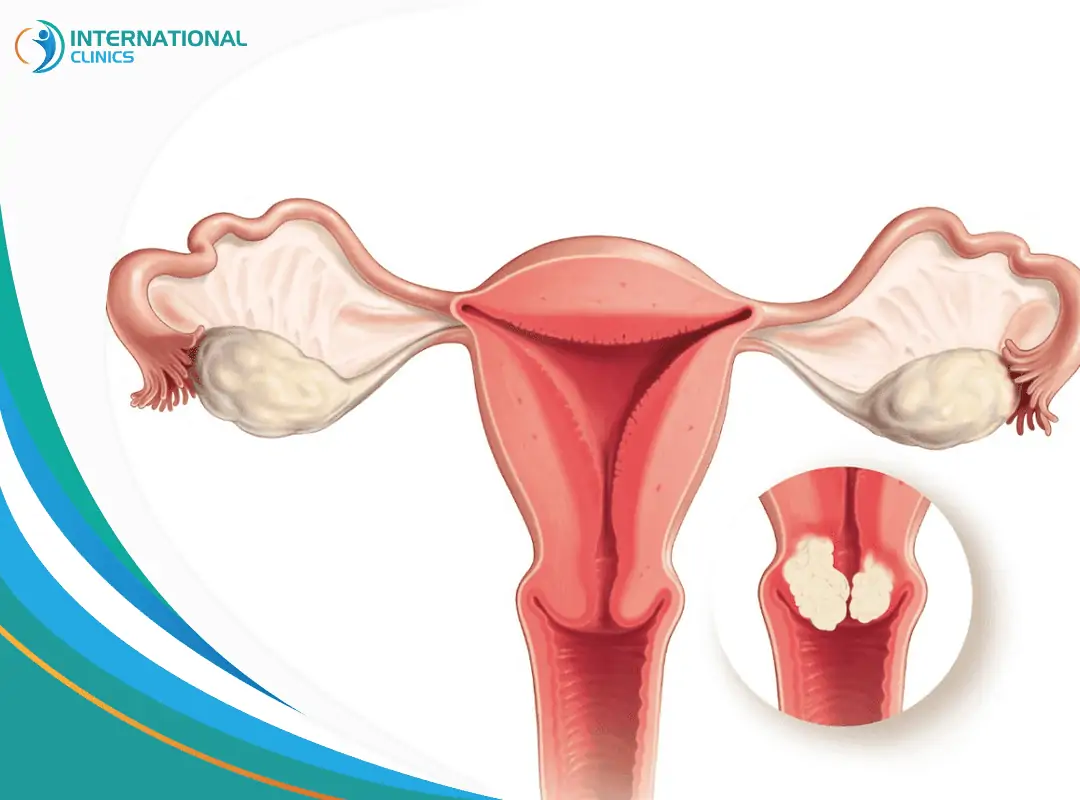 uterus cervicall cancer أعراض سرطان عنق الرحم