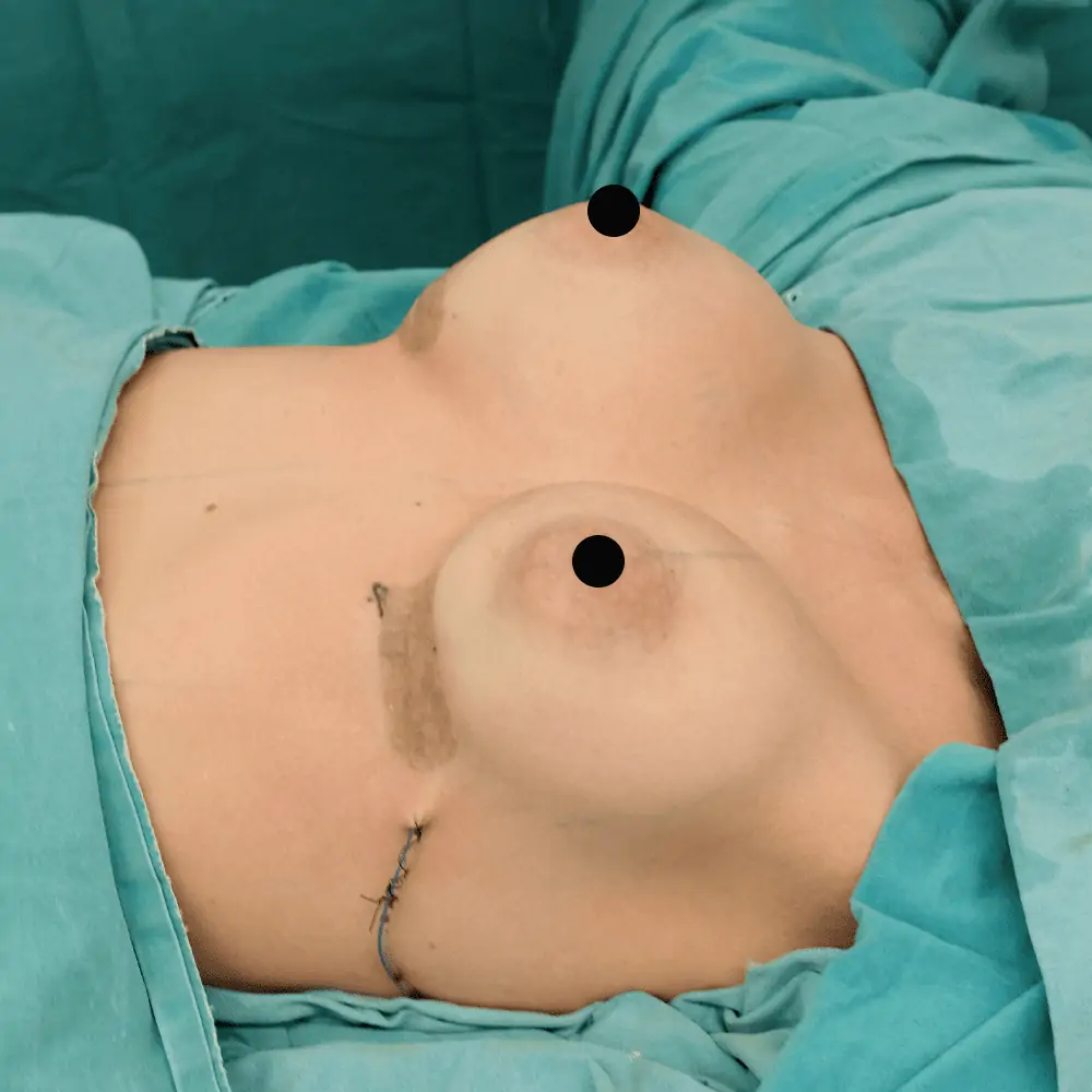 Breast aug after 4 1 عملية تكبير الثدي سيليكون