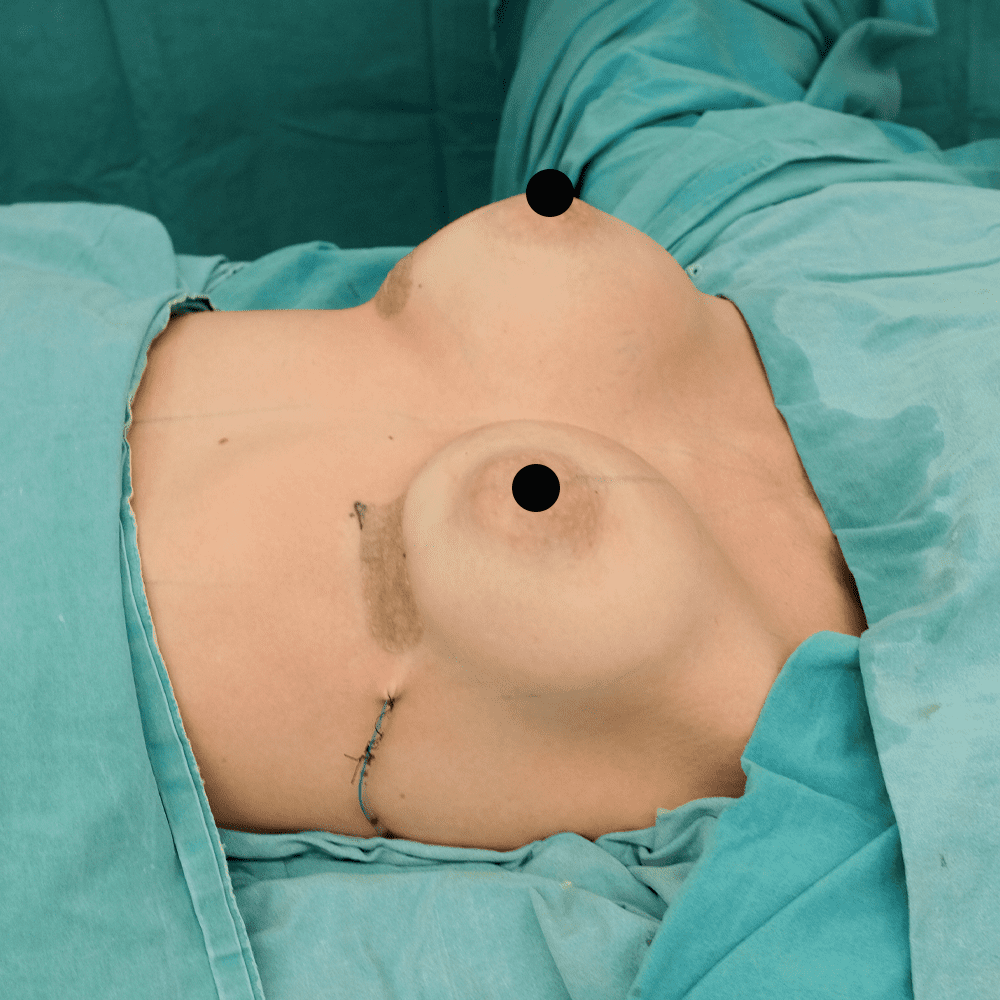 Breast aug after 4 جراحی پروتز یا بزرگ کردن سینه