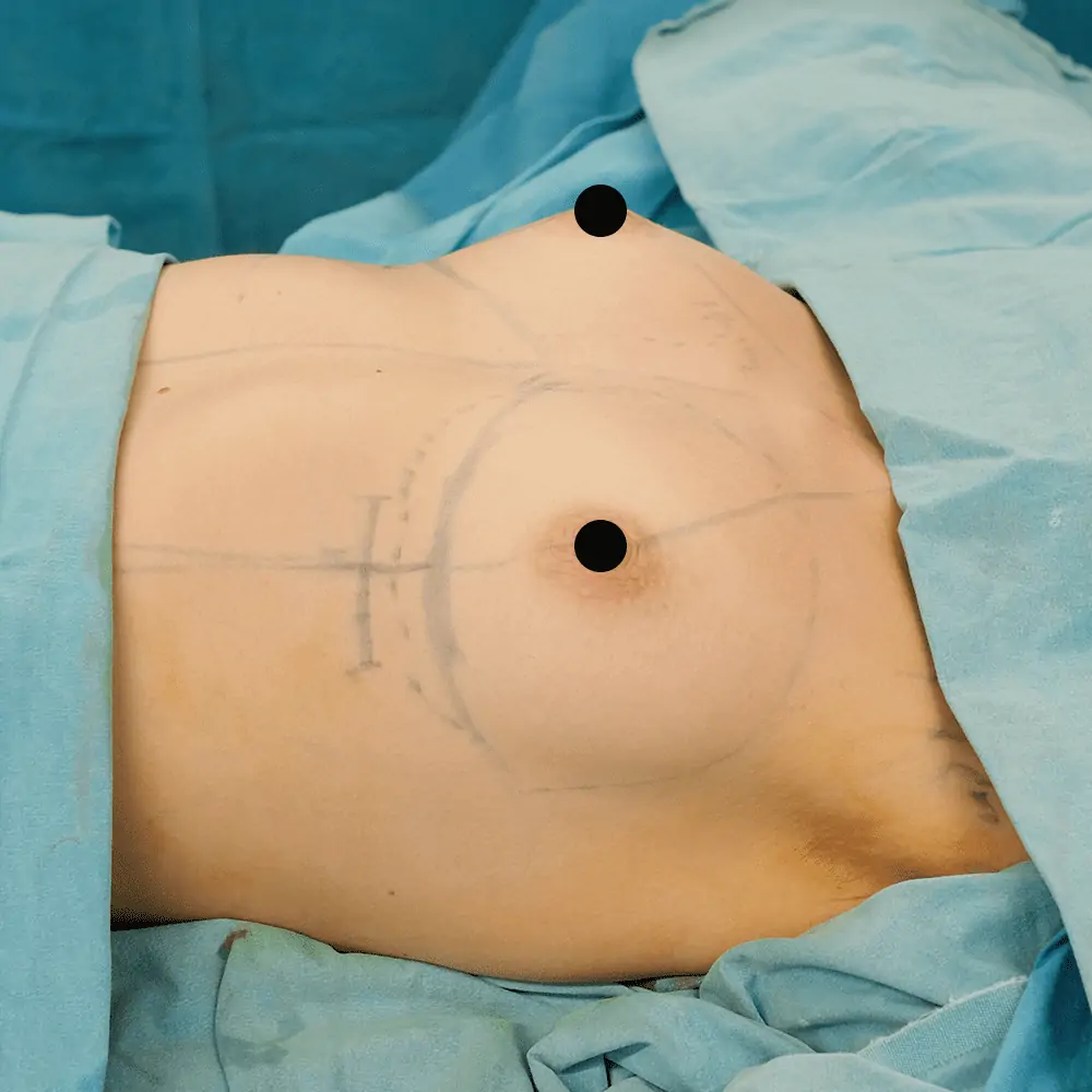 Breast aug before 4 Augmentation Mammaire