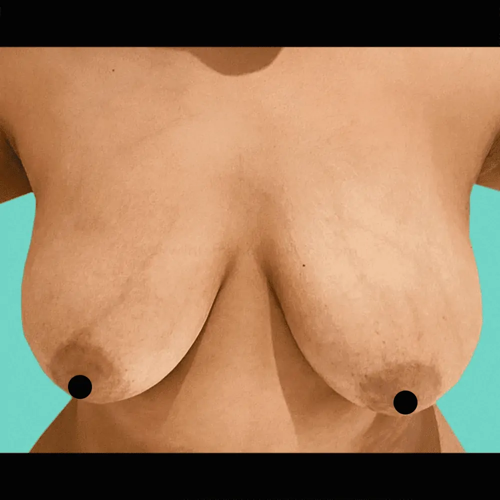 Breast red before 1 عمل کوچک کردن سینه در ترکیه