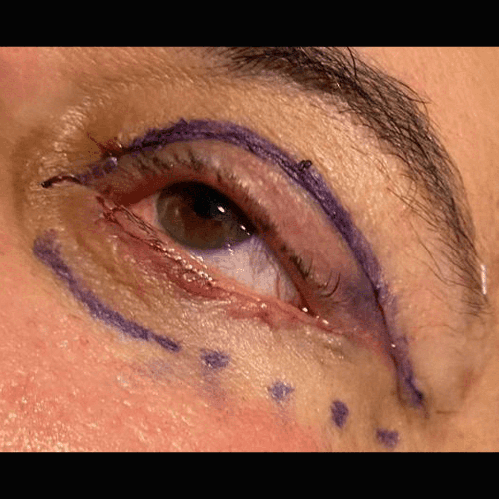 Eyelids after 1 Blepharoplasty