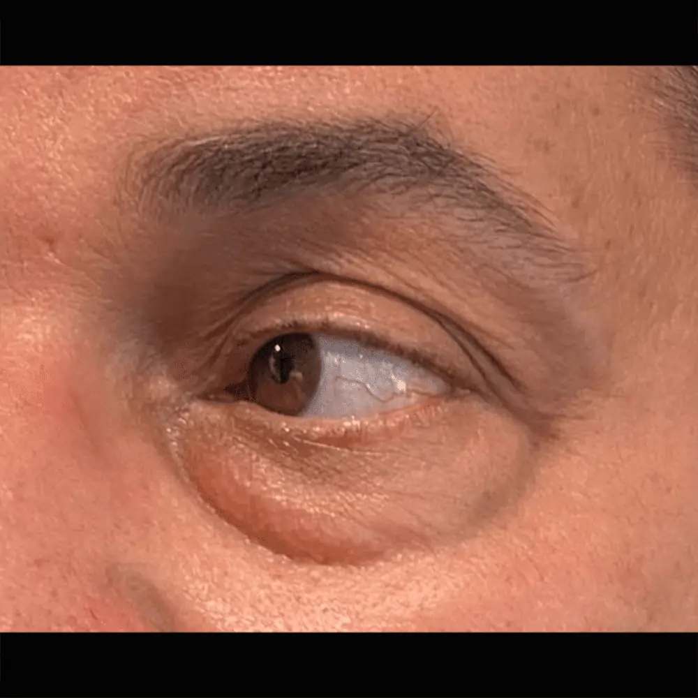 Eyelids before 1 Blepharoplasty,eyelid surgery,eyelid surgery cost
