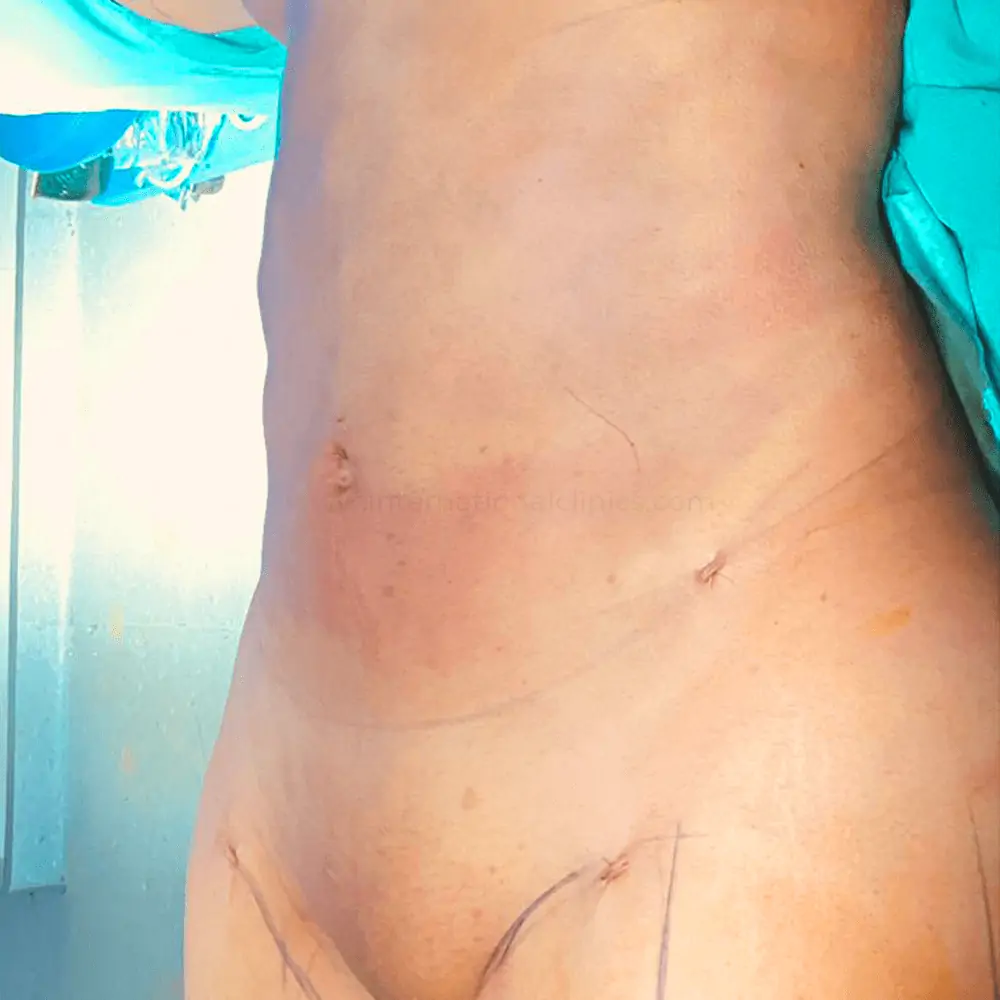 Liposuction after 4 جهاز الكافيتيشن