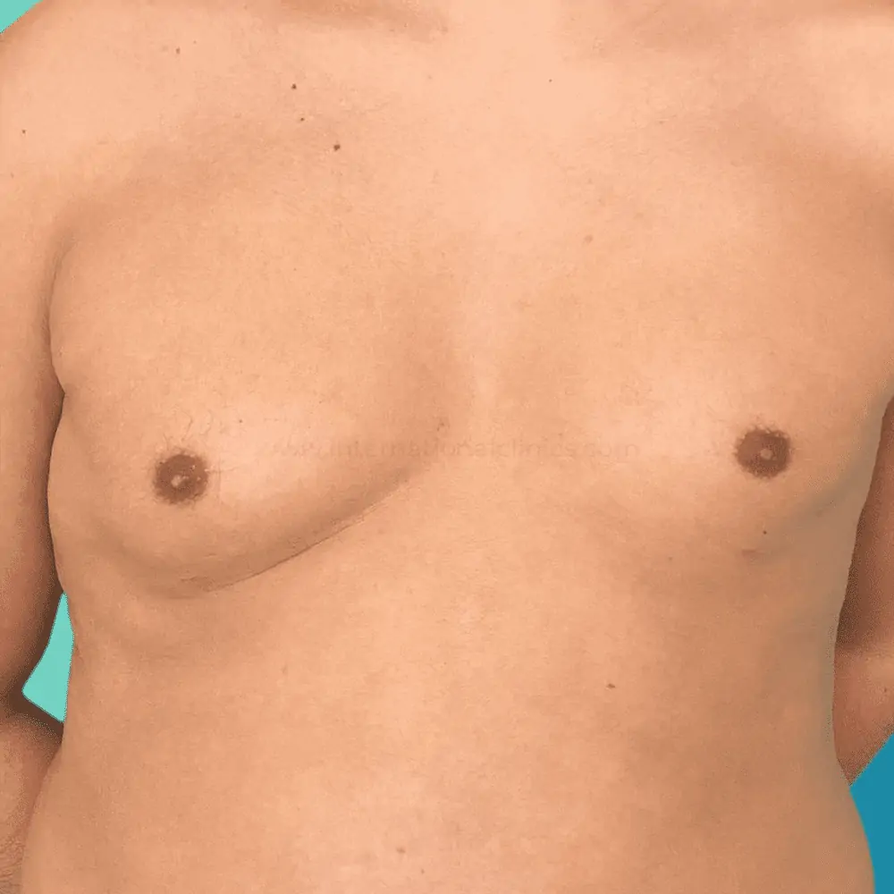 Liposuction before 3 شفط دهون الثدي للرجال