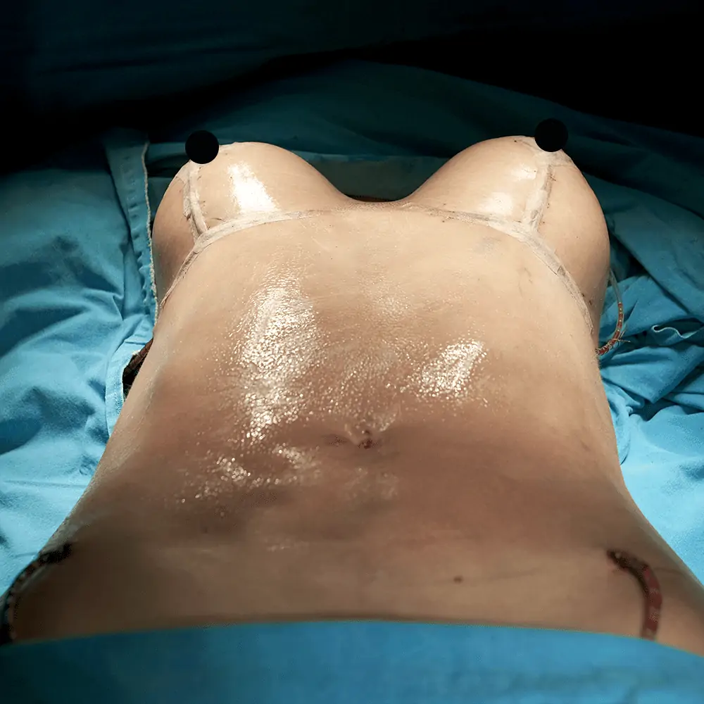 Mamoplasty after 1 Elevación de Pecho