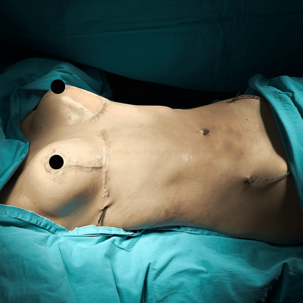 Mamoplasty after 2 شد الصدر