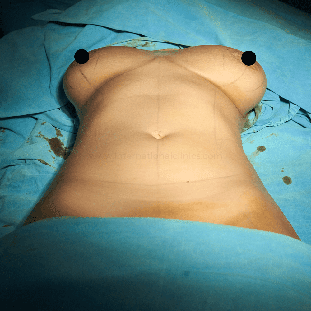 Mamoplasty before 1 1 Lifting des Seins