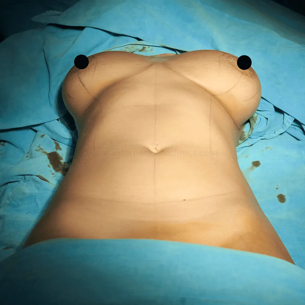 Mamoplasty before 1 2 Breast Lift in Turkey