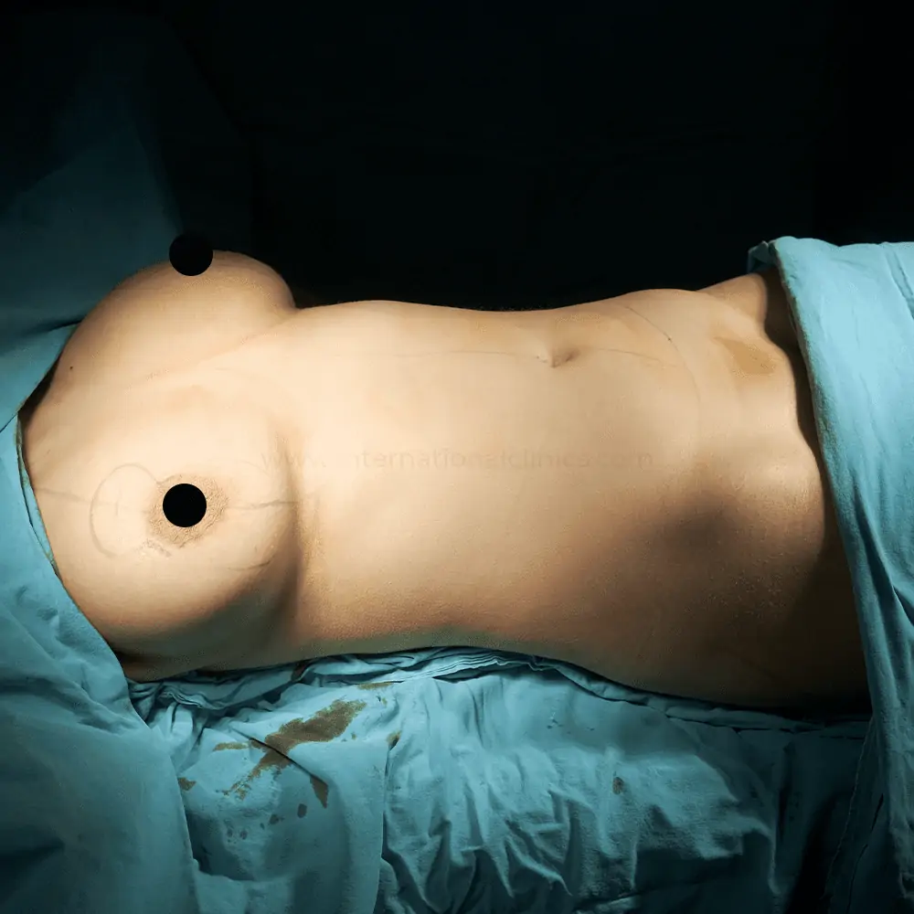 Mamoplasty before 2 شفط الدهون بالفيزر في تركيا