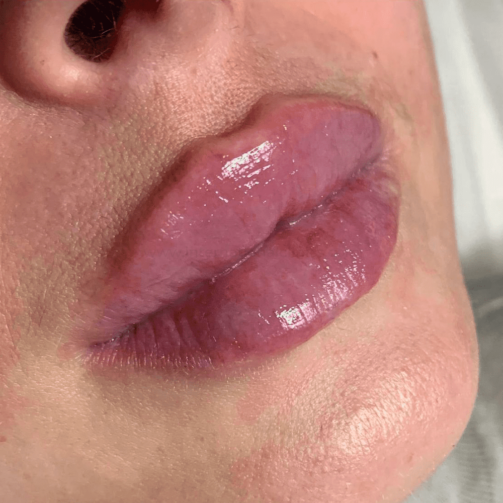 lips after 2 نفخ الشفاه