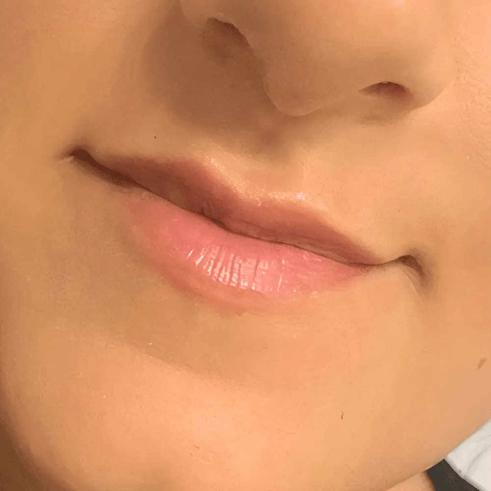 lips before 1 1 تجميل الشفايف