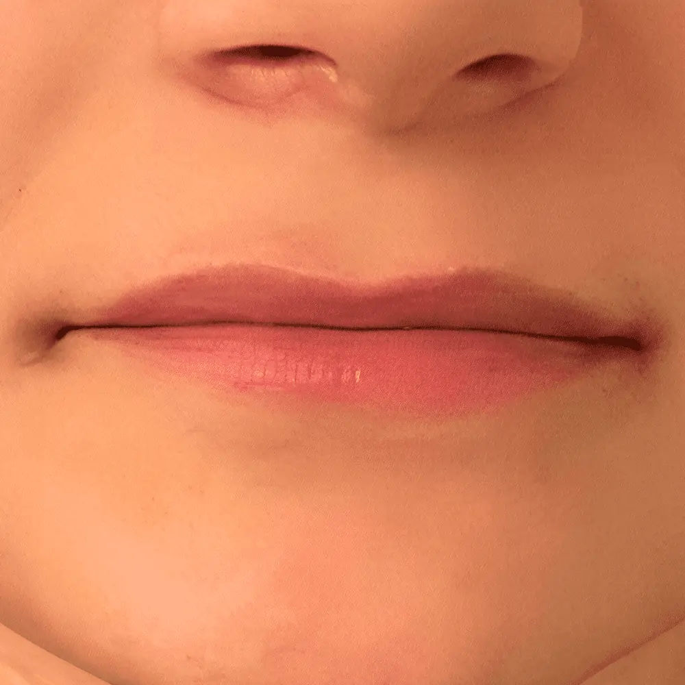 lips before 3 تكبير الشفايف