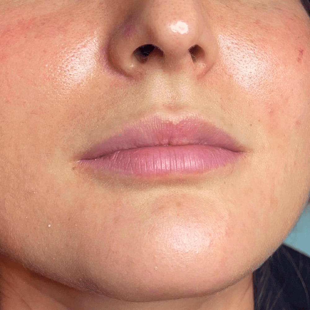 lips before 5 International Clinics