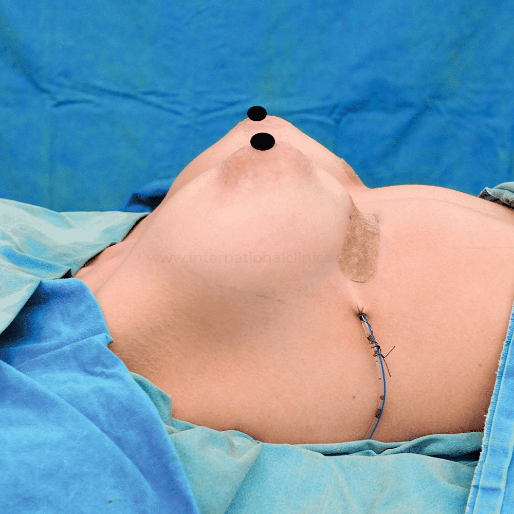 Breast aug after 5 Soins médicaux et esthétiques en Turquie