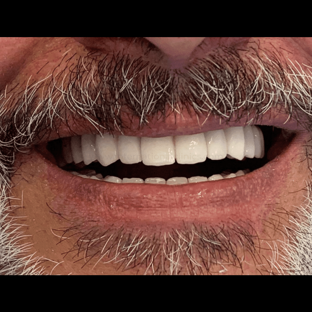 DentImplant After 1 Cirugía de Implantes Dentales