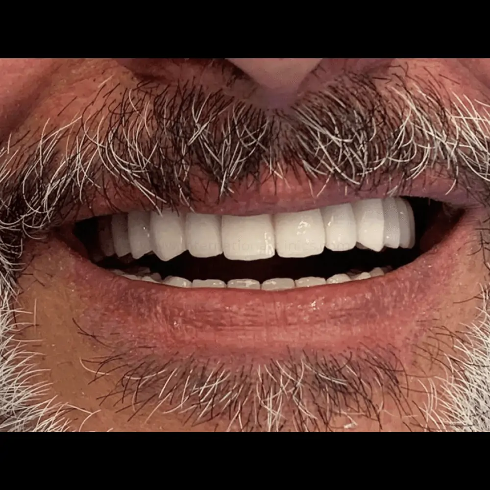 DentImplant After 1 زراعة الأسنان في تركيا