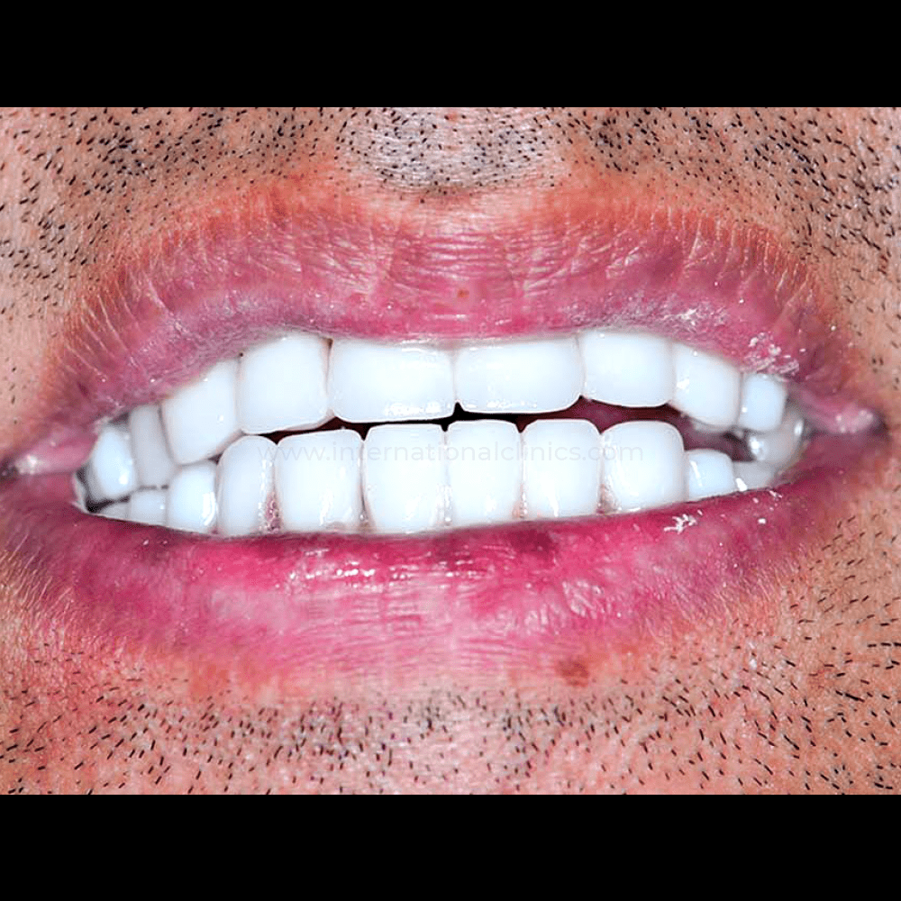 DentImplant After 2 زراعة الأسنان