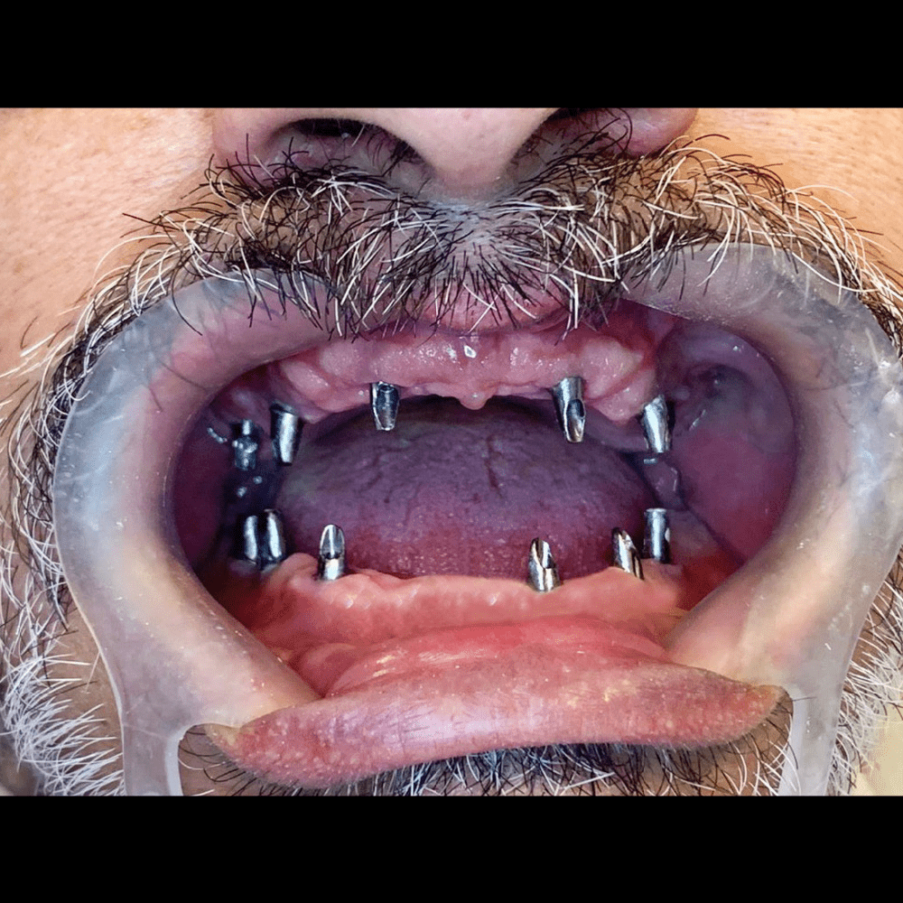 DentImplant Before 1 Cirugía de Implantes Dentales