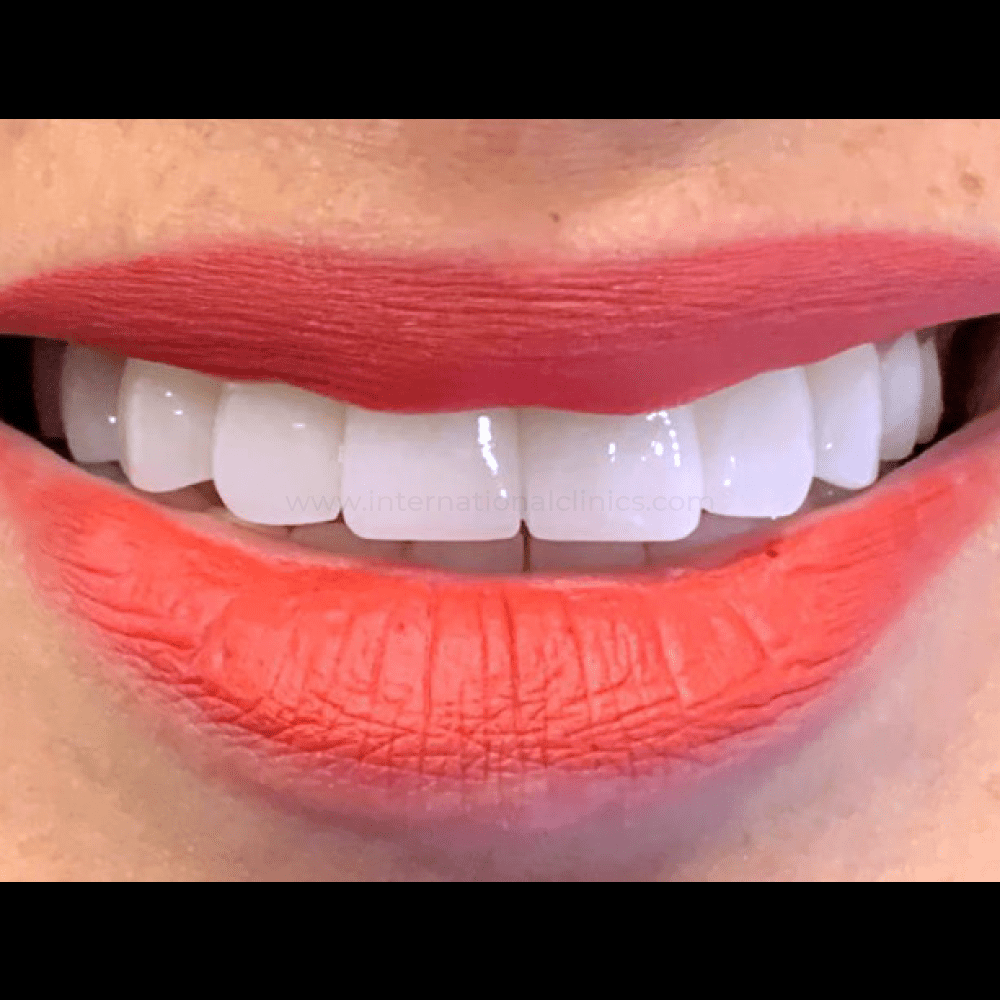 Dentcrown After 1 Hollywood Smile