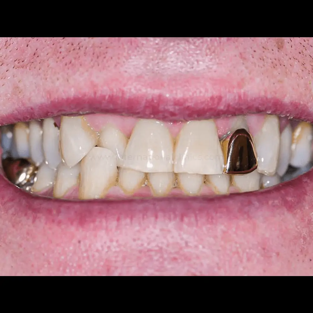 Dentcrown Before 3 تلبيسات لومينير الاسنان