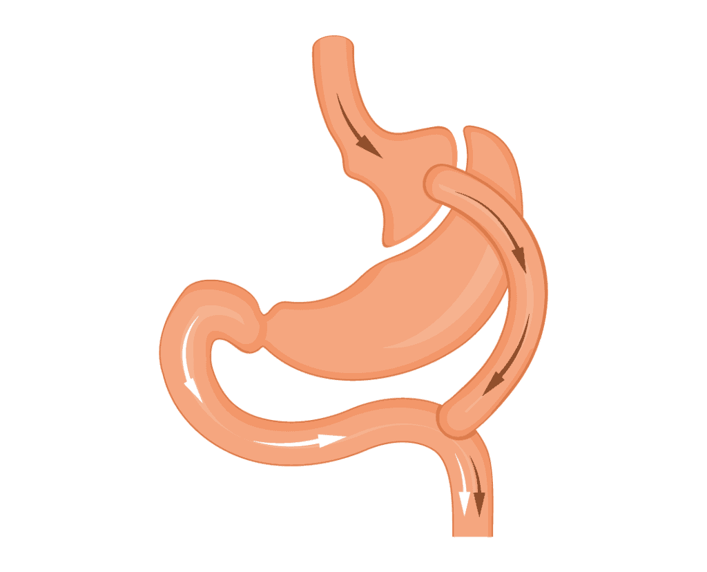 Gastric bypass 01 جراحی چاقی در ترکیه