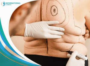 Tummy Tuck in Turkey: Everything You Need to know 2024