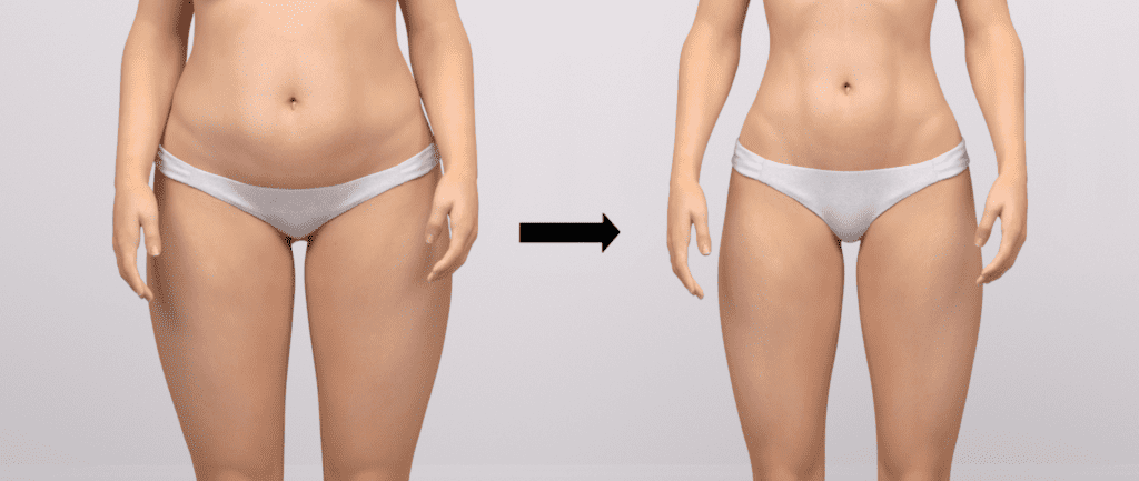 پیکرتراشی در ترکیه یکی از روشهای محبوب برای زنانی است که با هدف لاغری، کاهش حجم چربی و تناسب اندام در نقاط مختلفی از بدن صورت می گیرد.