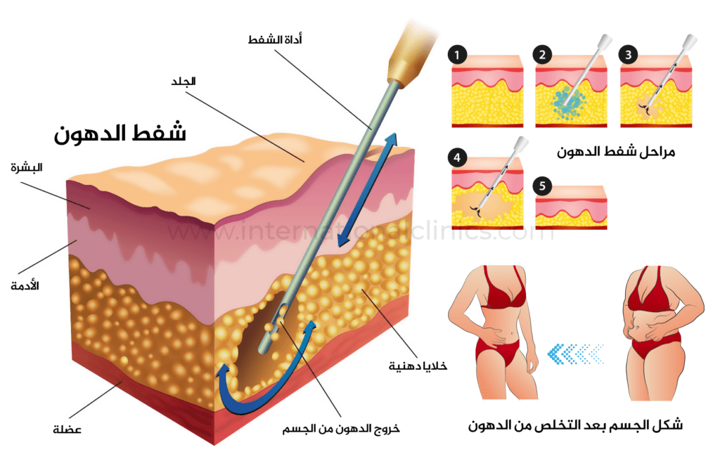 عمليات شفط الدهون مجانًا