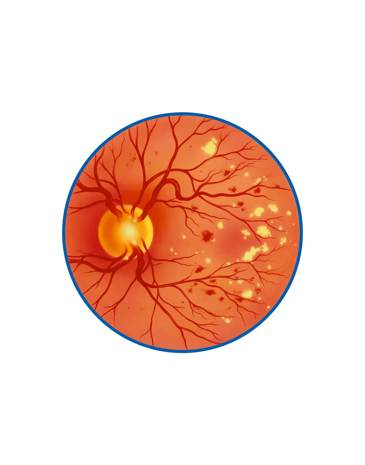 Диабетическая ретинопатия         (витрэктомия)