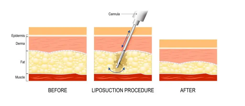 Abdominal liposuction 2 لیپوماتیک یا لیپوساکشن